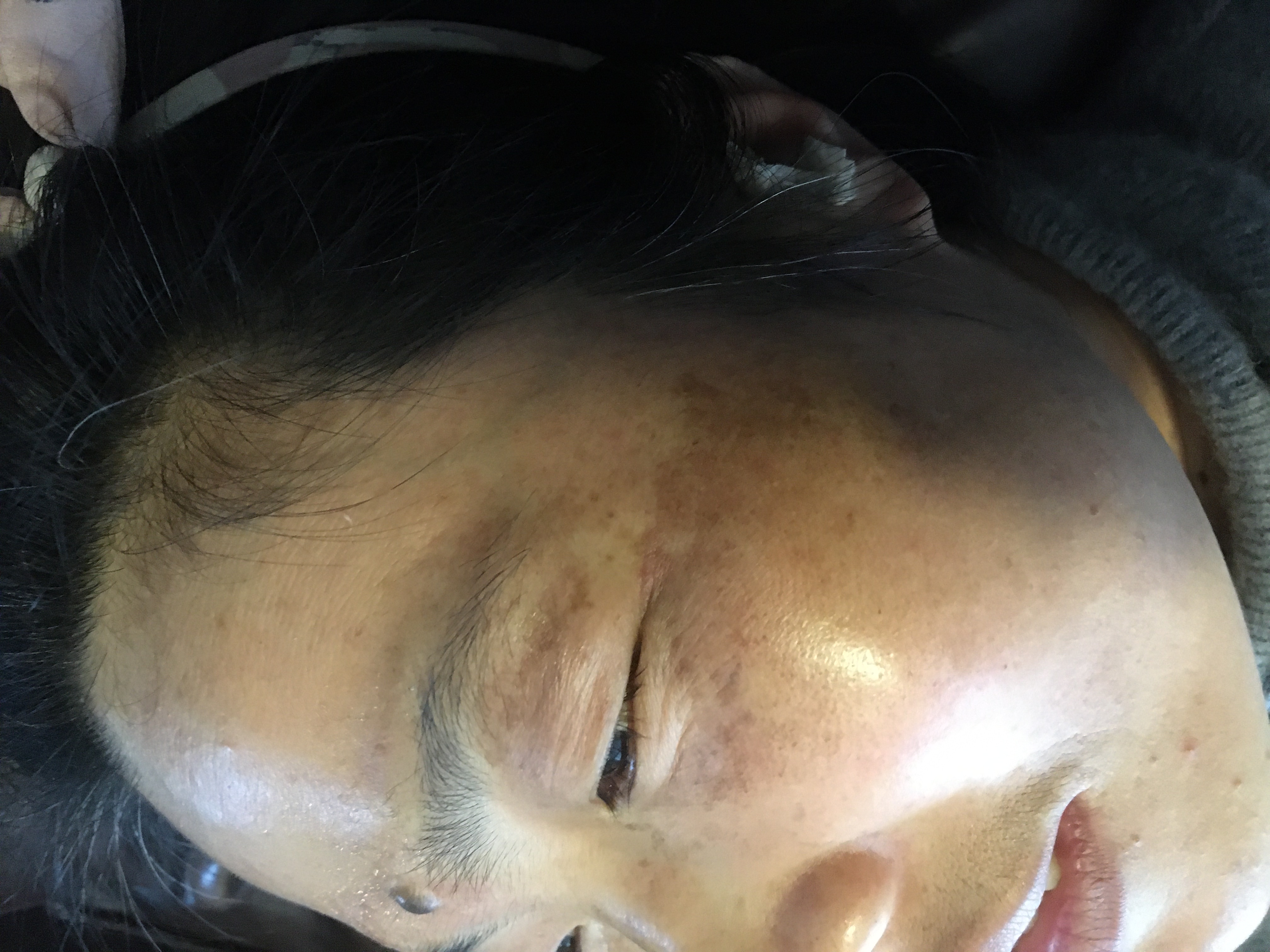 压力山大生长位置:颧骨脸颊发病时间:三年以上炎症性色素沉着身体素质